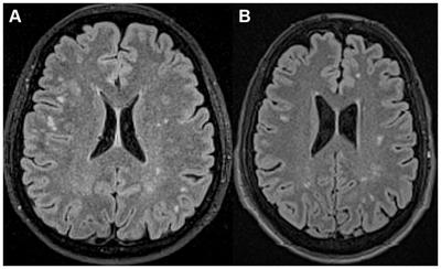 Differentiation of hemispheric white matter lesions in migraine and multiple sclerosis with similar radiological features using advanced MRI